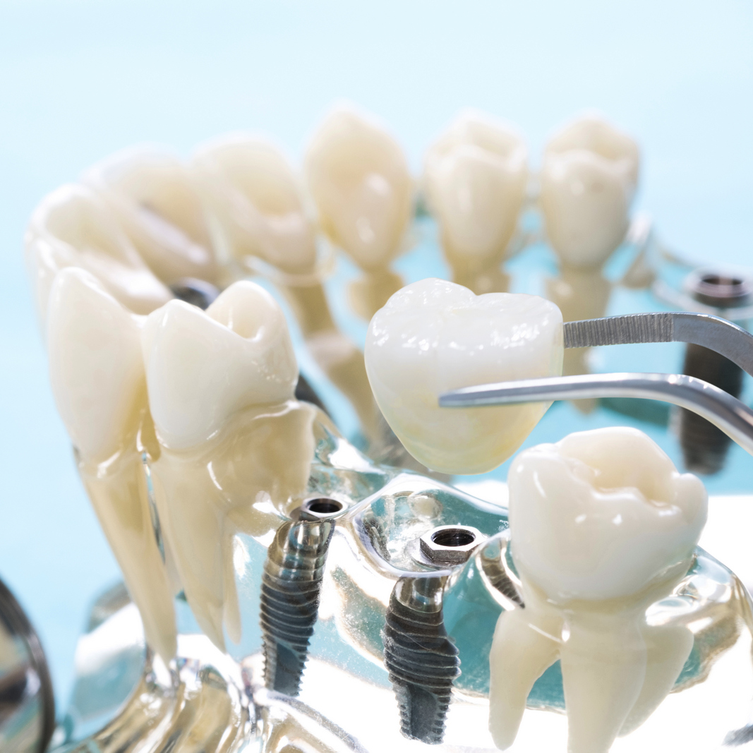 台中植牙費用、植牙流程與植牙診所推薦全攻略